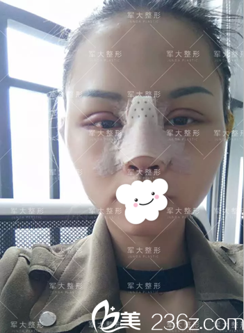 <i data-id='2257c2bc-36a4-4e95-bc55-f7ec9c660362' style='display:none;'></i>全切双眼皮术后3天 <i data-id='2257c2bc-36a4-4e95-bc55-f7ec9c660362' style='display:none;'></i>全切双眼皮术后3天