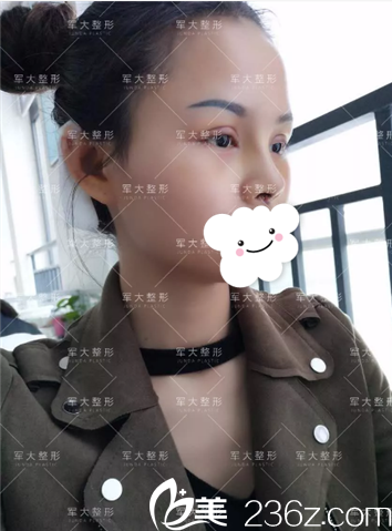 <i data-id='2257c2bc-36a4-4e95-bc55-f7ec9c660362' style='display:none;'></i>膨体隆鼻术后5天拆线 <i data-id='2257c2bc-36a4-4e95-bc55-f7ec9c660362' style='display:none;'></i>膨体隆鼻术后5天拆线