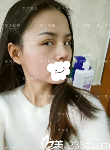 全切双眼皮+膨体隆鼻术后10天 全切双眼皮+膨体隆鼻术后10天