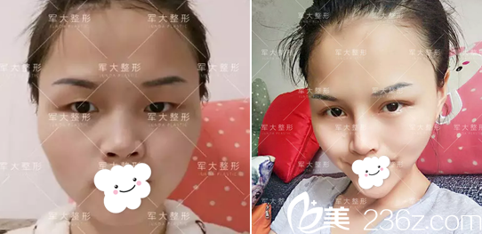 <i data-id='2257c2bc-36a4-4e95-bc55-f7ec9c660362' style='display:none;'></i>全切双眼皮+膨体隆鼻术前术后对比 <i data-id='2257c2bc-36a4-4e95-bc55-f7ec9c660362' style='display:none;'></i>全切双眼皮+膨体隆鼻术前术后对比