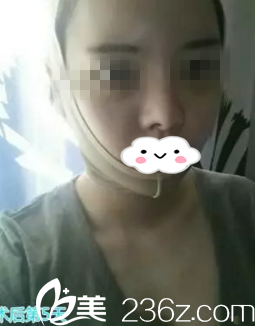 术后第五天 术后第五天