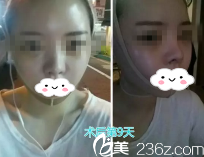 术后九天 术后九天