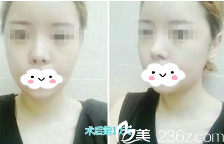 手术第十天 手术第十天