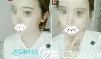 韩国春天金起雄院长面部轮廓整形，让我变成了气质女神