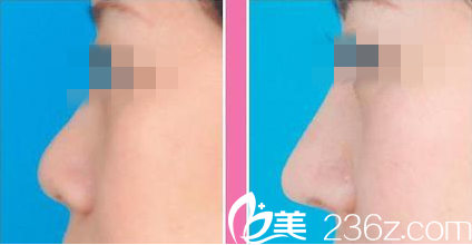 蒋松林医生隆鼻前后对比 蒋松林医生隆鼻前后对比