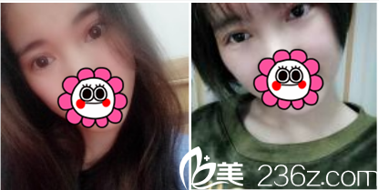 术后23天的样子