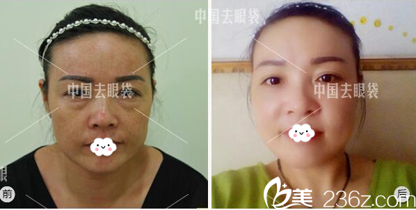 广州美诗沁医疗美容医院祛眼袋案例对比图