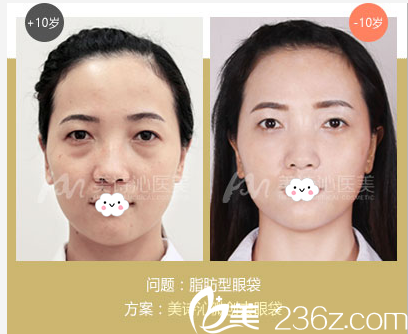 广州美诗沁医疗美容医院脂肪性祛眼袋案例