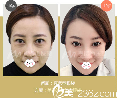 广州美诗沁医疗美容医院衰老型眼袋祛除案例