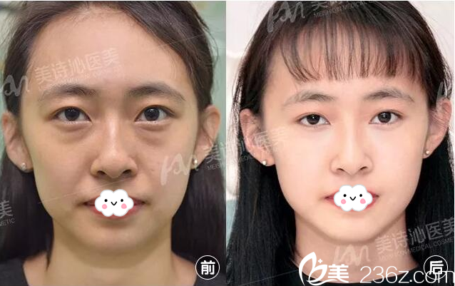 广州美诗沁医疗美容医院不开刀祛眼袋案例对比图