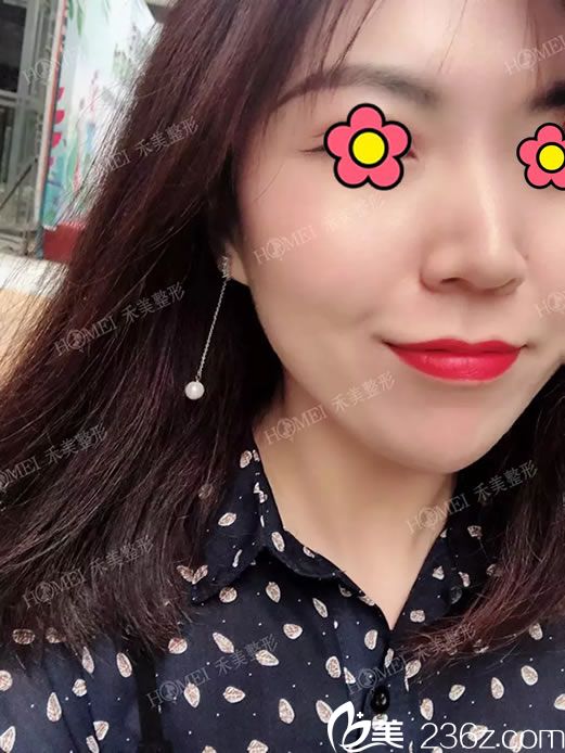 注射玻尿酸丰下巴的即刻效果图 注射玻尿酸丰下巴的即刻效果图