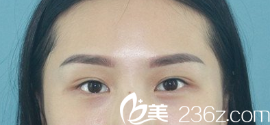 <!--<i data=20240703-sp></i>-->双眼皮修复术前照 <!--<i data=20240703-sp></i>-->双眼皮修复术前照