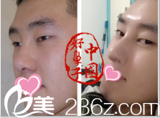 北京美丽有约医疗美容诊所隆鼻修复效果