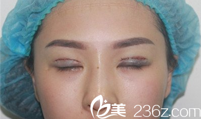 <!--<i data=20240703-sp></i>-->杨明峰双眼皮失败修复术后当天照片 <!--<i data=20240703-sp></i>-->杨明峰双眼皮失败修复术后当天照片