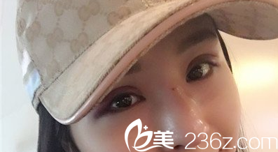 杨明峰医生双眼皮整形失败修复术后第三天照片