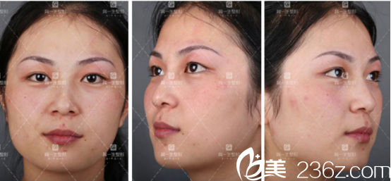 分享我在宝鸡高一生整形医院做的全切双眼皮手术 分享我在宝鸡高一生整形医院做的全切双眼皮手术