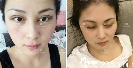 不得不说术后第三天肿的很猛啊 不得不说术后第三天肿的很猛啊