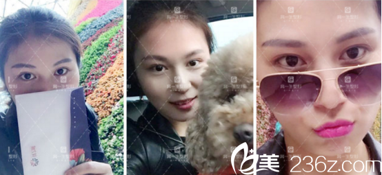 现在完全消肿了,但是还有些增生在恢复 现在完全消肿了,但是还有些增生在恢复