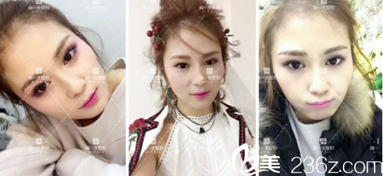 没想到宝鸡高一生做全切双眼皮手术挺好的，现在分享我的恢复过程