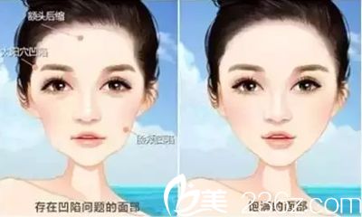 自体脂肪面部填充价格贵吗？南宁亚韩自体填充29800元起就能帮拥有心形脸