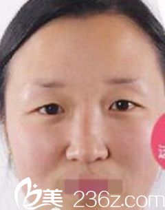 在洛阳孔繁荣做眼综合术前 在洛阳孔繁荣做眼综合术前