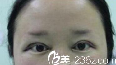 在洛阳孔繁荣做眼综合手术 在洛阳孔繁荣做眼综合手术