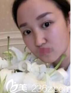 洛阳孔繁荣做眼综合案例 洛阳孔繁荣做眼综合案例