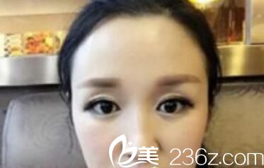 我在洛阳孔繁荣整形做了眼综合因为单纯双眼皮手术都不能拯救我的眼睛 