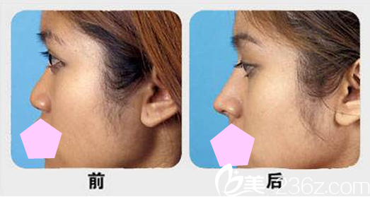 晋城矿务局烧伤整形科鼻综合隆鼻案例对比图