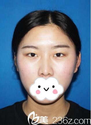 眼鼻整形术前样子 眼鼻整形术前样子