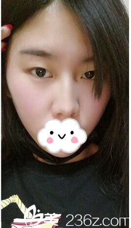 做完鼻综合术后一月恢复 做完鼻综合术后一月恢复