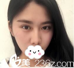 韩式双眼皮术后三天恢复 韩式双眼皮术后三天恢复