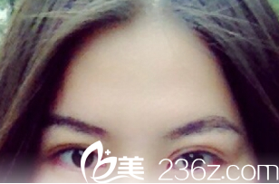 术后1个月的样子 术后1个月的样子