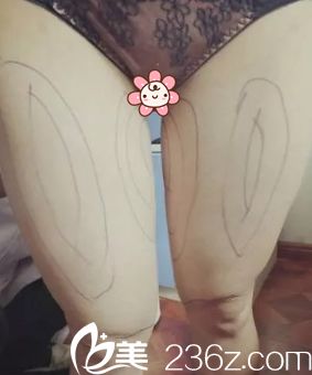 去重庆美仑美奂整形医院面诊 去重庆美仑美奂整形医院面诊