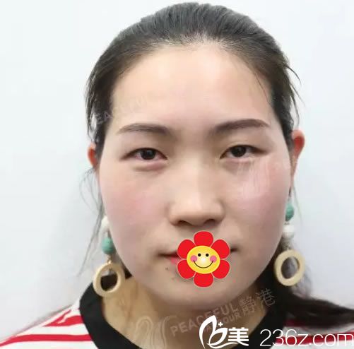 我在静港做双眼皮手术前的照片 我在静港做双眼皮手术前的照片