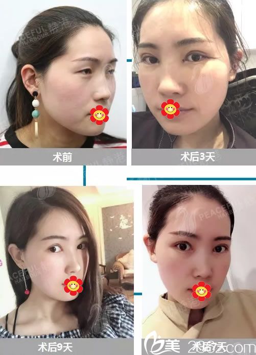 选择宁波静港林忠泵做双眼皮恢复过程 选择宁波静港林忠泵做双眼皮恢复过程