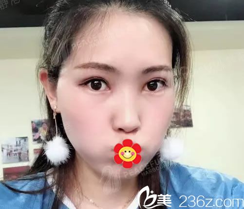 静港林中泵割双眼皮案例效果 静港林中泵割双眼皮案例效果