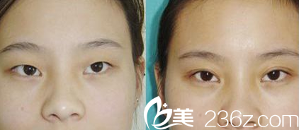 晋城矿务局医院整形科程红林主任双眼皮案例对比图