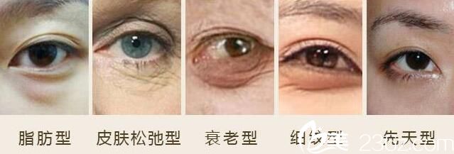 眼袋的几种类型