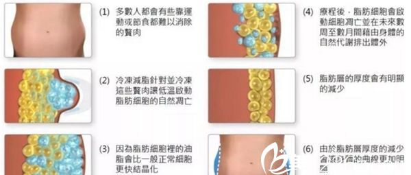 冷冻溶脂多少钱做一次？长春卢立平冷冻溶脂19800元起帮你塑造性感身材