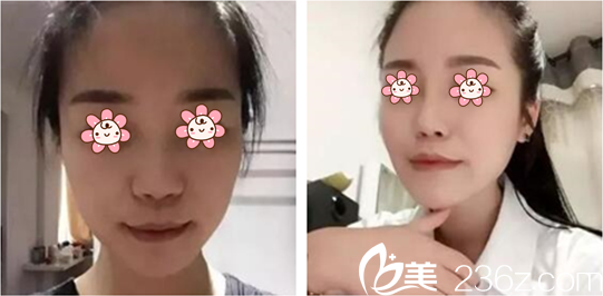 金胜翰院长隆鼻案例 金胜翰院长隆鼻案例