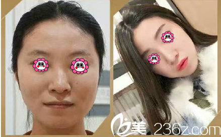 你被北京微丽医院方跃明注射丰太阳穴+瘦脸+隆鼻效果哪一项美到