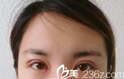 晋城矿务局医院烧伤整形科双眼皮术后第7天照