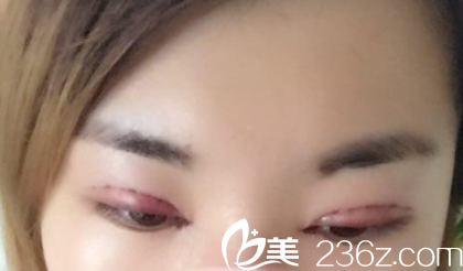 晋城矿务局整形美容科双眼皮术后第三天照片