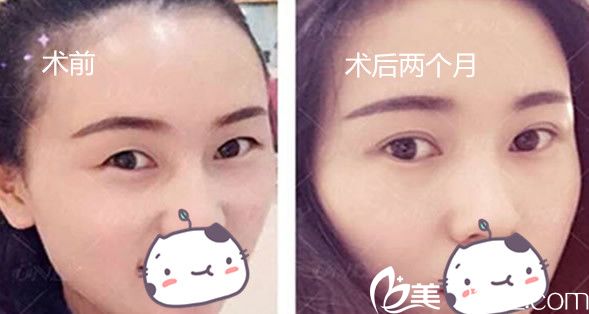 芜湖壹就爱壹<!--<i data=20240703-sp></li>
<li><i data=20240703-sp></i>-->双眼皮两个月对比<span style=