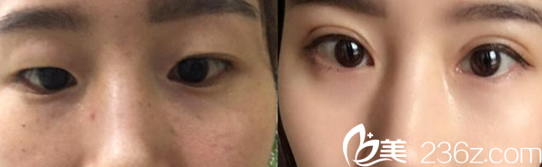 运城丽都切开双眼皮案例对比图