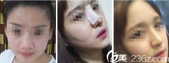 运城丽都杨顺新医生隆鼻案例图