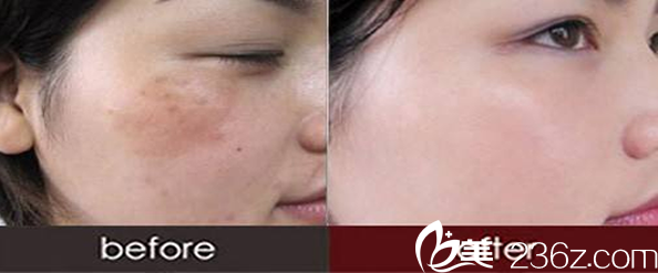 运城丽都祛斑效果图