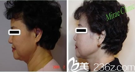 全脸和颈部提升除皱术前与术后8个月对比照片
