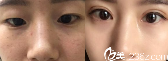 运城华美<!--<i data=20240703-sp></i>-->医生双眼皮案例对比图 运城华美<!--<i data=20240703-sp></i>-->医生双眼皮案例对比图